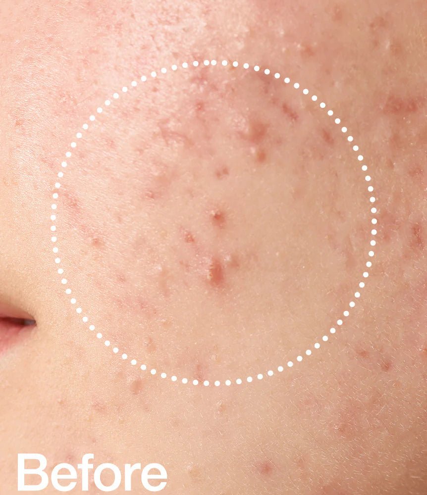 Anua Bha Exfoliating Toner - MeStore - Anua