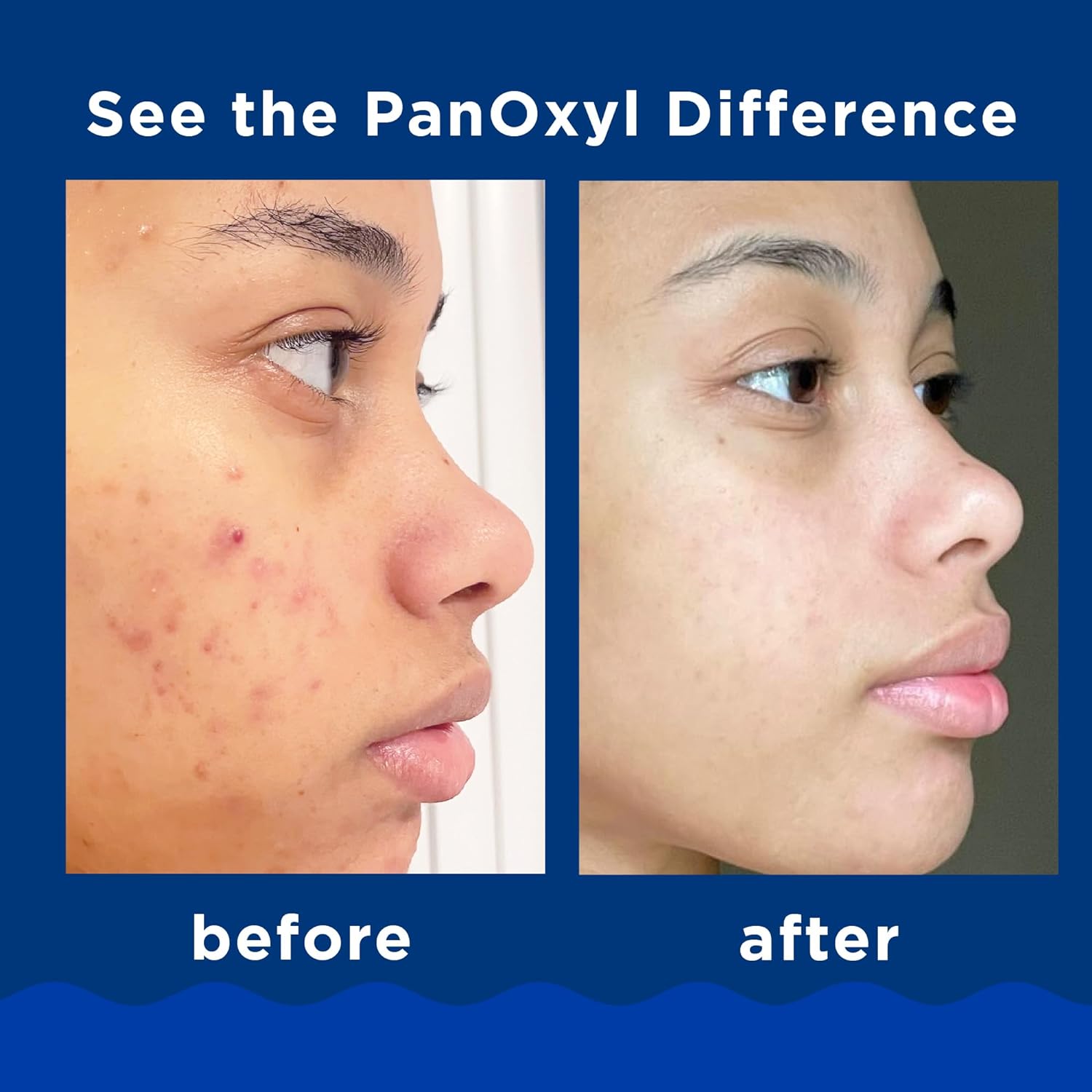 PanOxyl Acne Creamy Wash Benzoyl Peroxide 4% Daily Control - MeStore - PanOxyl