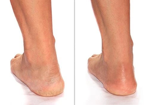 Advanced Clinicals Cracked Heel Cream - MeStore - Advanced Clinicals
